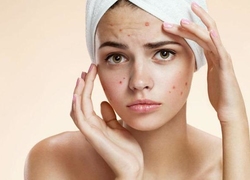 Фото: Гиперандрогения у подростков